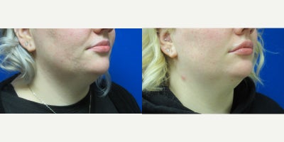 Juvderm, Lip Fillers - Patient wanted to have upper lip to have more fullness.  Dr. Eric Schaffer injected one syringe of Juvederm.