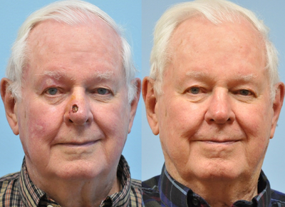 85 year old male treated for skin cancer defect - Bilobe flap reconstruction