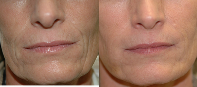 Juvederm - 
	This patient presented with concerns of deep and fine lines developing around the mouth. Options for management of this problem were discussed with the patient, including fillers, dermabrasion, a skin treatments. The patient elected to proceed with a combination of Radiesse and Juvederm. Dr. Thompson used Radiesse to fill the deeper lines, and with this base in place, Juvederm very effectively softened the fine facial lines.

