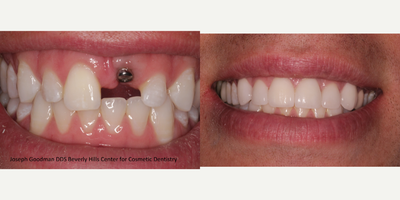 35-44 year old man treated with Mini Dental Implants - Mid 30 year old male had an extremely wide gap. This was a very challenging case since most dentists wanted to place an implant the size of the gap. With the help of porcelain veneers on the adjacent teeth and one implant, we were able to get a harmonious smile.