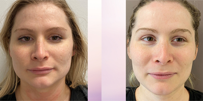25-34 year old woman treated with SkinPen - Amazing reduction in acne scars after just 2 treatments with SkinPen Microneedling.