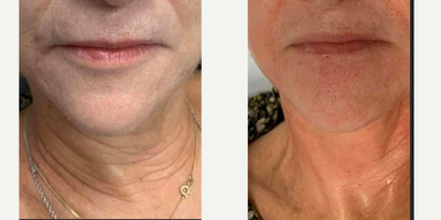 55-64 year old woman treated with Secret RF - Our clients results in her neck tightening and rejuvenation! These before and after pictures show her results after 3 Secret Rf treatments combined with platelet rich plasma .