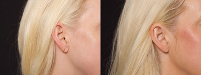 Woman treated with Earlobe Surgery - Woman treated with Earlobe Surgery