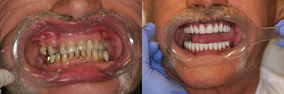 60 year old male treated with All-on-4 Dental Implant Procedure - 60 year old male treated with All-on-4 Dental Implant Procedure