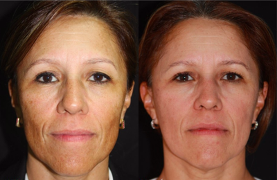 45-54 year old woman treated with Skin Lightening - Dark spots are reduced in 96% of the face.