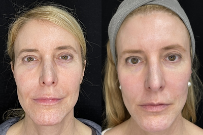 45-54 year old woman treated with Opus Plasma - Patient treated with full face Opus Plasma fractionated resurfacing, total 3 treatments each 1 month apart. Shown is before any treatments and 1 month following the final treatment. Both photos taken in the same light and background.