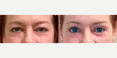 45-54 year old woman treated with Eyelid Retraction Repair - 45-54 year old woman treated with Ptosis Repair, Upper Blepharoplasty, Lower BlepharoplastyAge: 49yF Height: 52 Weight: 145 pounds BMI: 26.5 Time After Surgery: 3 Months