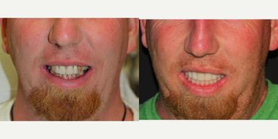 All-on-4 Dental Implants - All-on-4 Dental Implants