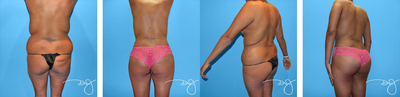 Butt Augmentation  - 
	This patient achieved the Buttock Augmentation through liposuction of flanks, lower abdomen, upper abdomen and inner thighs. She also had a tummy tuck and a breast augmentation along with her fat transfer, all at the same time
