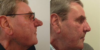 18-24 year old man treated with Laser Treatment - Diode laser de-bulking of Rhinophyma