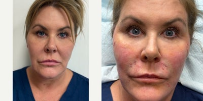45-54 year old woman treated with Lifestyle Lift - 46 year old female who wanted a facial lift without undergoing surgery. Before and after are the same day