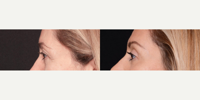 Woman treated with Brow Lift - Looking for a way to do away with sagging brows and replace it with a smoother, wrinkle-free forehead? Its time to ditch droopy eyebrows! A Brow Lift is a fantastic solution to refresh your face for those who are looking for results that last longer than Botox. As a double board certified facial plastic surgeon, I take pride in utilizing the latest techniques to allow this procedure to be completed in a relatively short period of time on an outpatient basis. Many patients fear that a brow lift will leave them permanently surprised or unnaturally wide eyed, however from these gorgeous results above it is clear to see that this procedure leaves you looking younger and subtly refreshed!