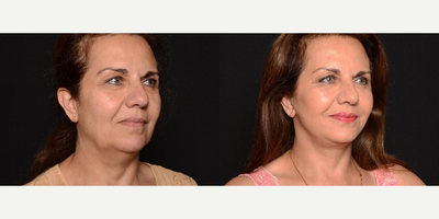 Woman treated with Facelift - Thought about having a facelift, but you dont know where to start? Look no further than Beyond Beautiful! The human face shows signs of aging more readily than other parts of the body due to the effects of sun, gravity, and muscle relaxation throughout the years, let us help you turn back the clock on your face and give you a new natural refreshed look that youll love. Here at Beyond Beautiful we specialize in the natural look, not the Hollywood stretched look that everyone fears. As a double board certified facial plastic surgeon, you can relax in a spa setting and have the surgery performed in an outpatient basis with little or no downtime.