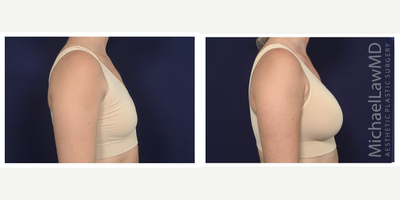 25-34 year old woman treated with Natrelle Breast Implants - Breast augmentation. Follow-up photo taken 1 month after the procedure.