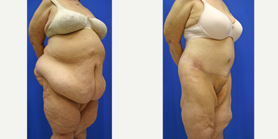 Body Lift  (side view R) - Body Lift