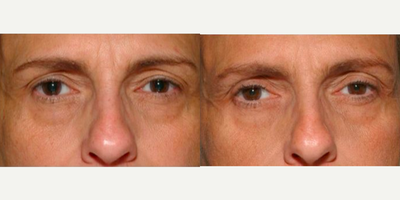 Woman treated with Thermage - Thermage
