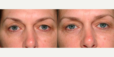 Woman treated with Thermage - Thermage