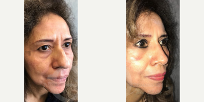 Woman treated with Eyelid Surgery - Woman treated with Eyelid Surgery