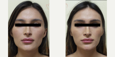 18-24 year old woman treated with Botox for TMJ - Jaw slimming with Botox, Dysport, Jeuveau or Xeomin injection into masseter muscle. Can also help with bruxism, teeth grinding/TMJ