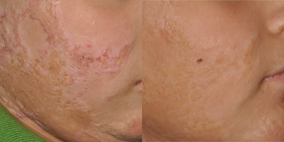 18-24 year old man with scars treated with  DeepFX and Erbium YAG - 18 y/o male with burn scars treated 5 times 2 months apart with laser
