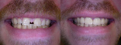 Large gap between front teeth corrected with crowns - 
	Large gap between front teeth corrected with crowns
