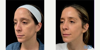 35-44 year old woman treated with NeoGen Plasma, Skin Tightening, Skin Rejuvenation - 90 days post procedure, this lovely patient is still seeing improvement with her results.