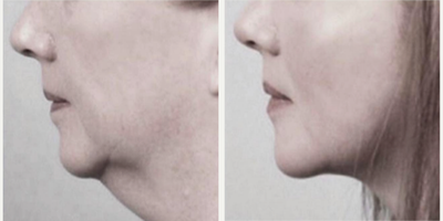 Woman treated with FaceTite - Woman treated with FaceTite