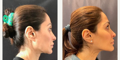 Woman treated with Nonsurgical Facelift - EMFACE Before & After of our very own Dr. Deborah Marciano! Noninvasive and No Downtime!
