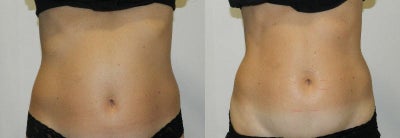 35-44 year old woman treated with Carboxytherapy - 6 sessions of carboxytherpay + ilipo