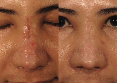 Sciton Profractional Laser Resurfacing for Traumatic Nose Scar - Laser resurfacing for traumatic nose scar.  Profractional laser resurfacing for dark skin.