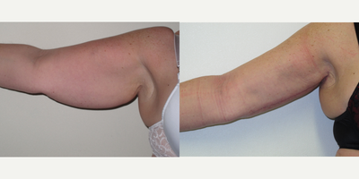 55-64 year old woman treated with Arm Lift - Brachioplasty- Arm lift