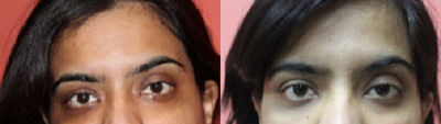 18-24 year old woman treated with Carboxytherapy - 26 years old who underwent 14 sessions of Carboxy therapy for Under Eye Dark Circles.