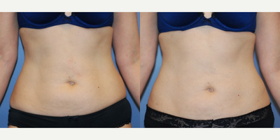 Liposuction - Woman treated with Liposuction