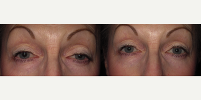 Left Upper Eyelid Ptosis Repair - Left upper eyelid ptosis repair