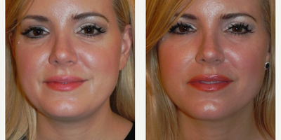 Woman treated with Kybella - Woman treated with Kybella
