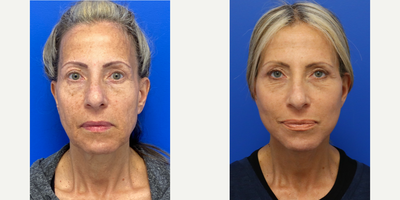 58 year old woman treated with Deep Plane Facelift - 58 year old woman treated with Deep Plane Facelift, Neck Lift, CO2 Laser, and Eyelid Surgery, shown 3 weeks post op.