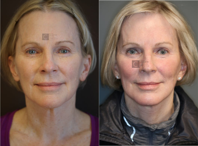 Lift and Laser - Minimally invasive face and necklift with laser resurfacing.