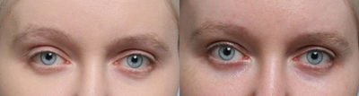 25-34 year old woman treated with Ptosis Surgery - 30 year old woman with right upper eyelid asymmetry and ptosis.Diagosis: Right upper eyelid levator disinsertionTreatment: Right upper eyelid anterior levator ptosis repair and anchor blepharoplasty