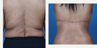 55-64 year old woman treated with Body Lift - Bra Line Back Lift