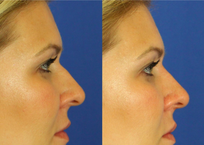 35-44 year old woman treated with Non Surgical Nose Job - Nonsurgical rhinoplasty to treat dorsal hump.