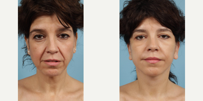 Woman treated with Lower Facelift - Woman treated with Lower Facelift