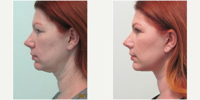 35-44 year old woman treated with SMAS Facelift - This young mother of two in her early 40s presented with the concern of excessive drooping skin of her jawline and neck after her pregnancies.  She attempted a few non-surgical options (ie ultherapy and fillers) without any significant improvement.  She consulted with us with the hope of a more semi-permanent and long-lasting option.Physical examination revealed significant laxity of both the skin and muscle layers of her lower face and neck which hid her natural attractive anatomy (cheeks and chin).Being a young mother, she was fearful of undergoing deep sedation (ie general or IV anesthesia), thus she preferred the method of our Center (local anesthesia with mild oral sedation with xanax).  We agreed to perform a SMAS lower facelift along with a concurrent neck lift.  Procedure time was slightly less than 2 hours time.Her results show sharpening of all of her lower facial and neck angles along with maintaining a natural appearance.