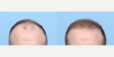 25-34 year old woman treated with FUE Hair Transplant, Hair Transplant, Hair Loss Treatment, PRP for Hair Loss, PRP Injections - This 28-year-old patient started noticing hair loss and had a lot of recession in temporal region. Dr. Wise performed an FUE hair transplant along with one session of PRP during the procedure to get these results. He will continue to see results up until 1 year mark.