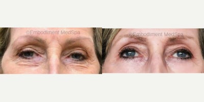 55-64 year old woman treated with Renuvion for Facial Resurfacing - This patient had Renuvion Facial Renewal to her upper and lower eye lids.