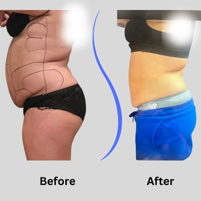 35-44 year old woman treated with Funsculpting - Lipo-360 on 41 year old female with Funsculpting method. Patient down 5 inches on waistline in just 1 treatment. Stubborn fat successfully removed from belly, flanks and lower back.