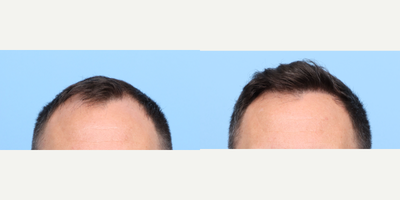 25-34 year old man treated with FUE Hair Transplant, Hair Transplant, Hair Loss Treatment, PRP for Hair Loss - This patient aimed to rebuild his hairline that was receding and add overall density. Dr. Wise performed an FUE hair transplant and PRP Hair Therapy on this patient, during which he placed2,510 grafts to zone 1 of the patient's scalp.