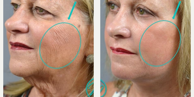 Woman treated with Facelift, Brow Lift, Eyelid Surgery - Woman treated with Facelift, Brow Lift, Eyelid Surgery