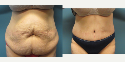 45-54 year old woman treated with Mommy Makeover - Tummy tuck with diastasis rectus repair