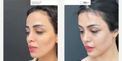 25-34 year old woman treated with Chin Implant, Brow Lift - Chin&Jaw Implant, Brow Lift