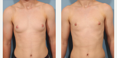 17 or under year old man treated with FTM Chest Masculinization Surgery - chestwall reconstruction, top surgery, female to male chest masculinization surgery